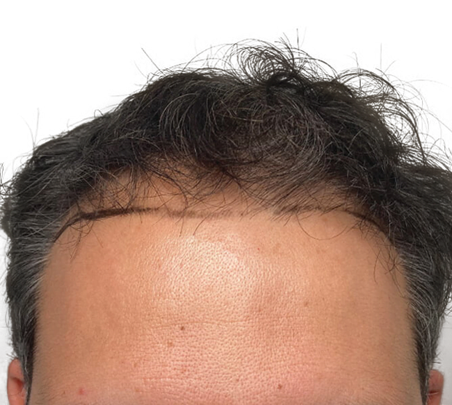 Northern Virginia Hair Tranplant Services Contact Us Today