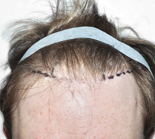 Northern Virginia Hair Tranplant Services Contact Us Today