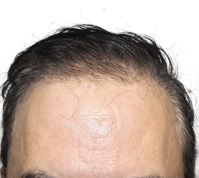 Northern Virginia Hair Tranplant Services Contact Us Today