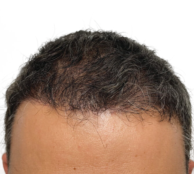 Northern Virginia Hair Tranplant Services Contact Us Today