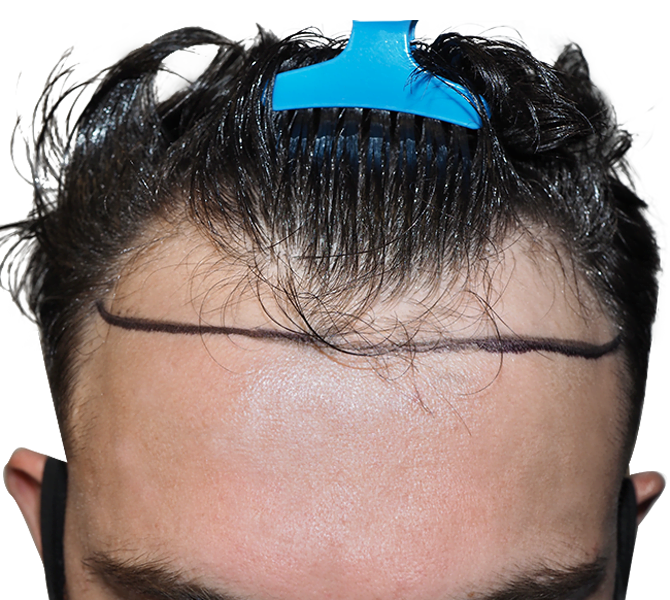 Northern Virginia Hair Tranplant Services Contact Us Today