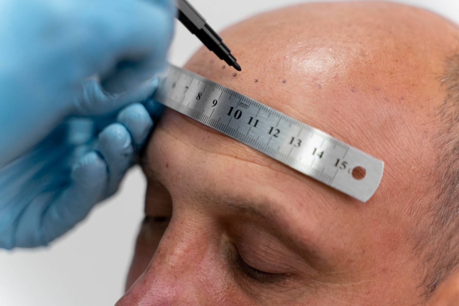 patient outcomes after hair transplant in Virginia
