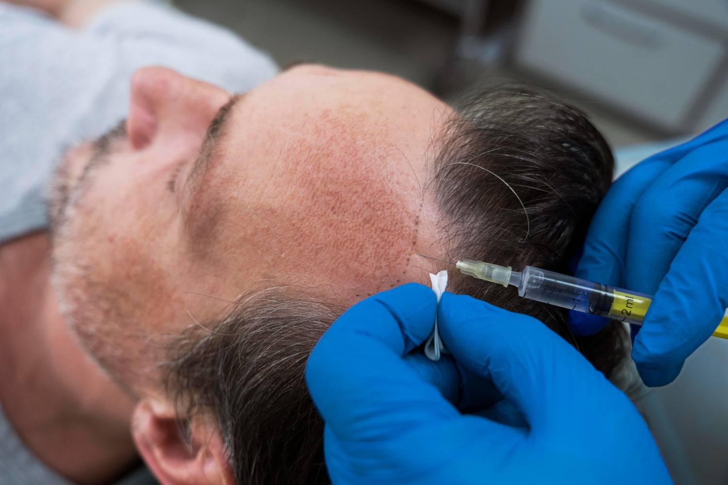 scar correcting hair transplant procedures