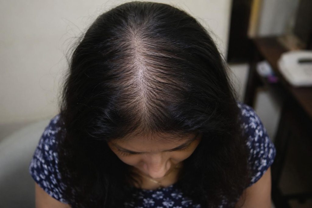 female pattern hair loss treatment