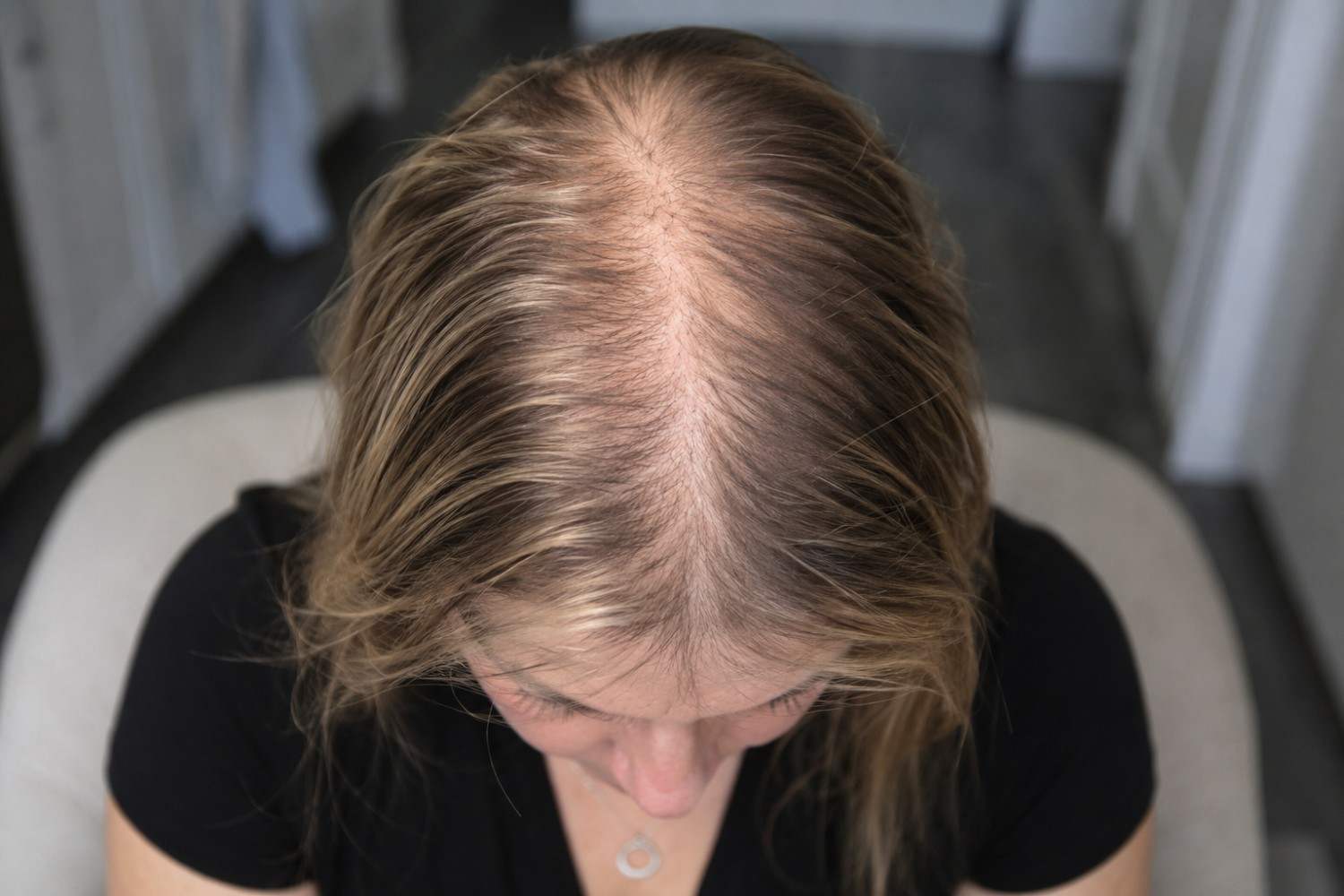 treatment for female pattern hair loss